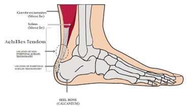 Achilles tendinopathy 2