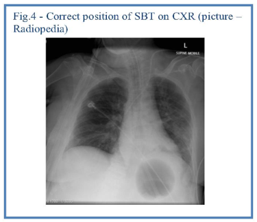Correct position of S-BT on CXR