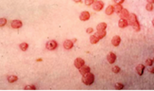 Extensive molluscum in immunosuppressed image